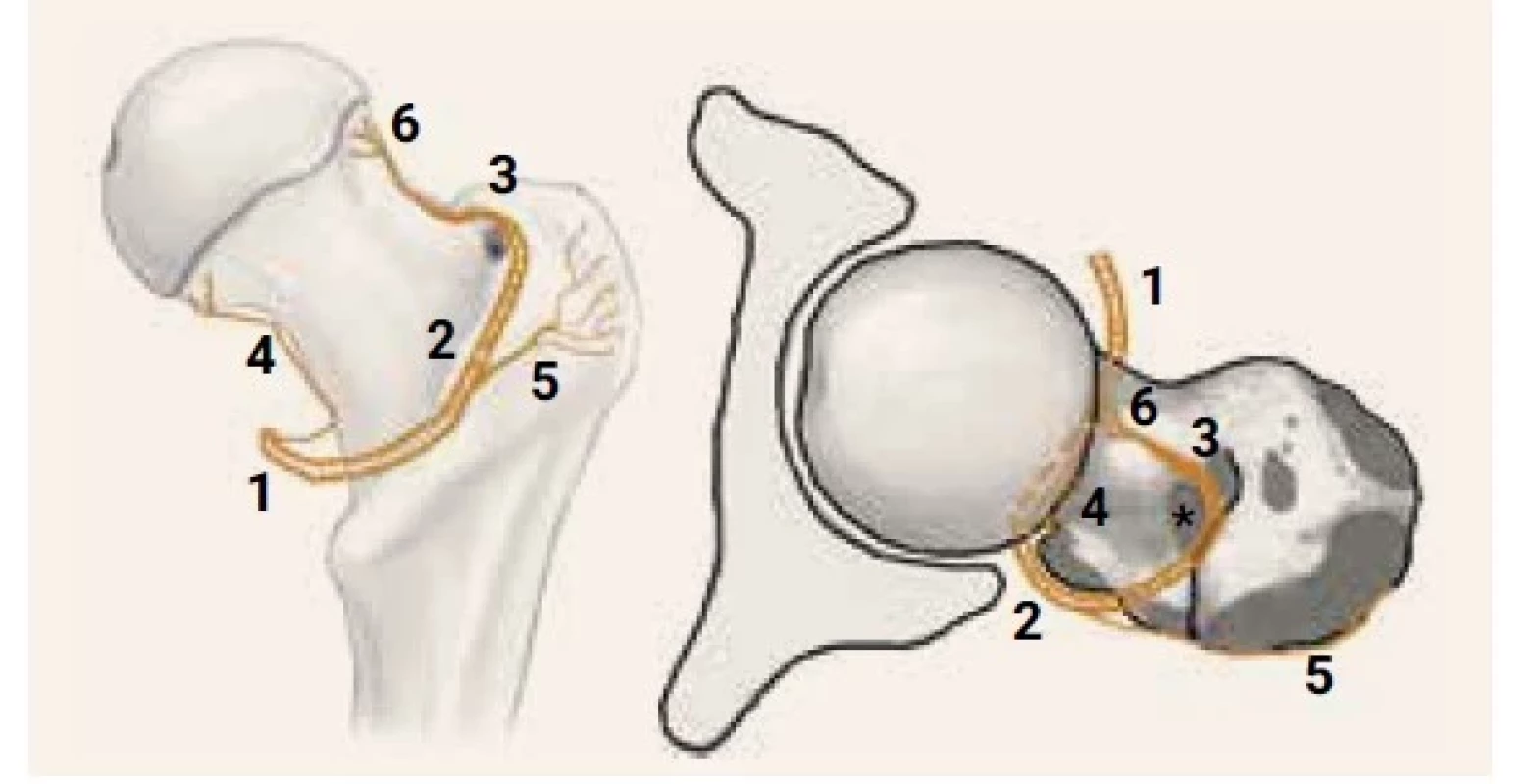 Schematické znázornenie priebehu MFCA.
Pohľad na pravý proximálny femur zhora
(obr. 3.1). Pohľad na pravý proximálny femur
zozadu (obr. 3.2)