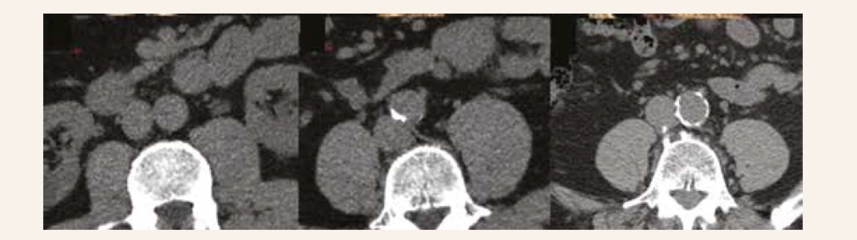 Axial slices presenting abdominal QCT scans: no abdominal aortic calcification (left panel),
mild calcification limited to right posterior quandrant (middle panel), and severe calcification nearly
on the entire circumference (right panel). Reproduced with senior author´s permission [26]