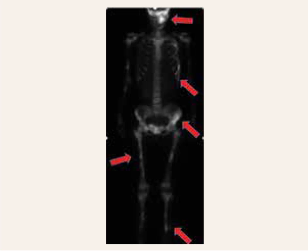 Scintigrafické změny při fibrózní dysplazii. Postižení žeber, především na levé straně hrudníku, dále v pánvi, v levé kosti kyčelní, mnohočetná drobná ložiska jsou patrná v dlouhých kostech, a to v obou femurech, tibiích v levé fibule a v obou humerech