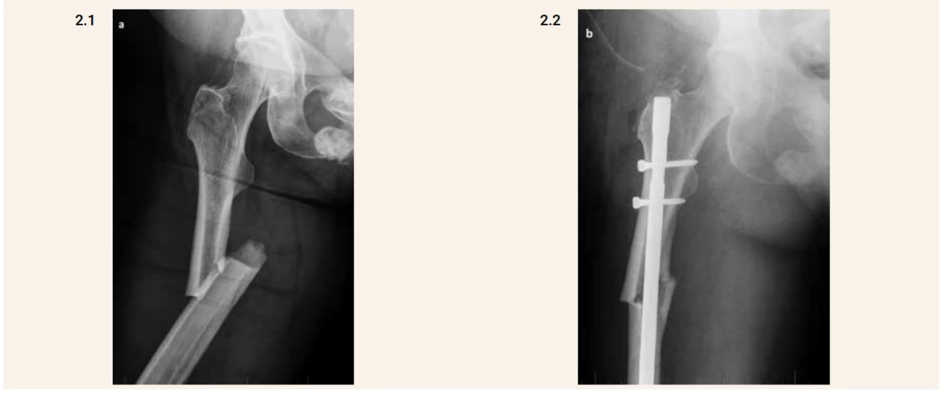 Kompletní atypická fraktura diafýzy femuru vpravo (2.1) a pooperační snímek (2.2). Je patrný horizontální průběh lomné linie v laterálním ztluštělém kortexu a dále šikmý průběh mediálním směrem.
Šikmý typ zlomeniny je lépe vidět na pooperačním snímku 