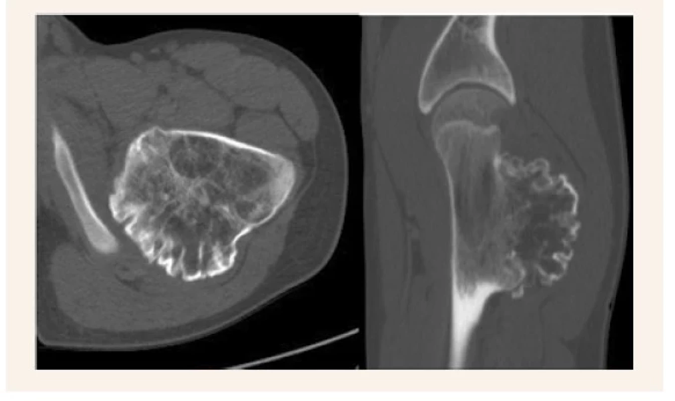 CT – transverzálny rez s potvrdením ischiofemorálneho
syndrómu (obr. 2.1). CT – sagitálny
rez zobrazujúci dorzálnu propagáciu tumoru
(obr. 2.2)
