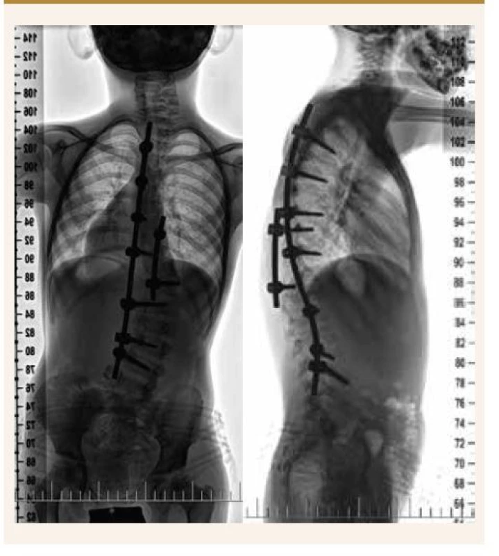 RTG-snímky 8 mesiacov od operačného výkonu
na chrbtici.