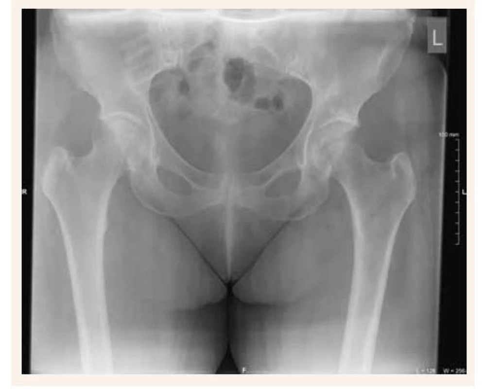 Prvotná RTG-snímka bedrových kĺbov bez
evidentného patologického nálezu