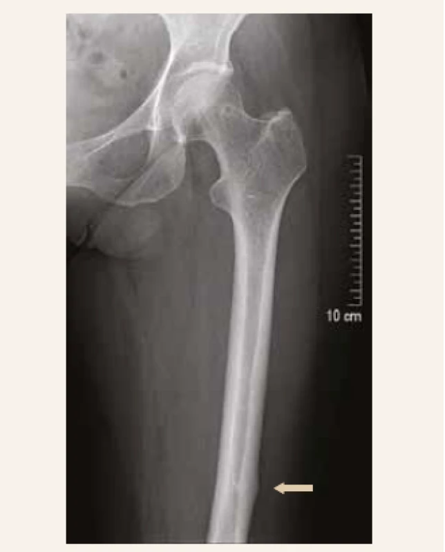 RTG-snímek levé stehenní kosti (19. 7. 2019 po 6 měsících léčby): asymetrické zesílení distální diafýzy levého femoru; zhojená fraktura
