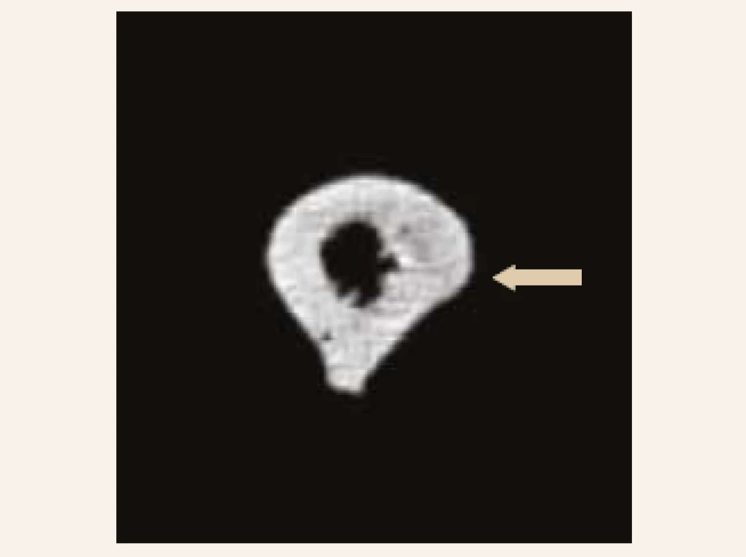 CT-scan levé stehenní kosti (11. 1. 2019, vstupní): horizontálně probíhající vlasová linie v laterální části kortikalis ve střední třetině diafýzy levého femoru