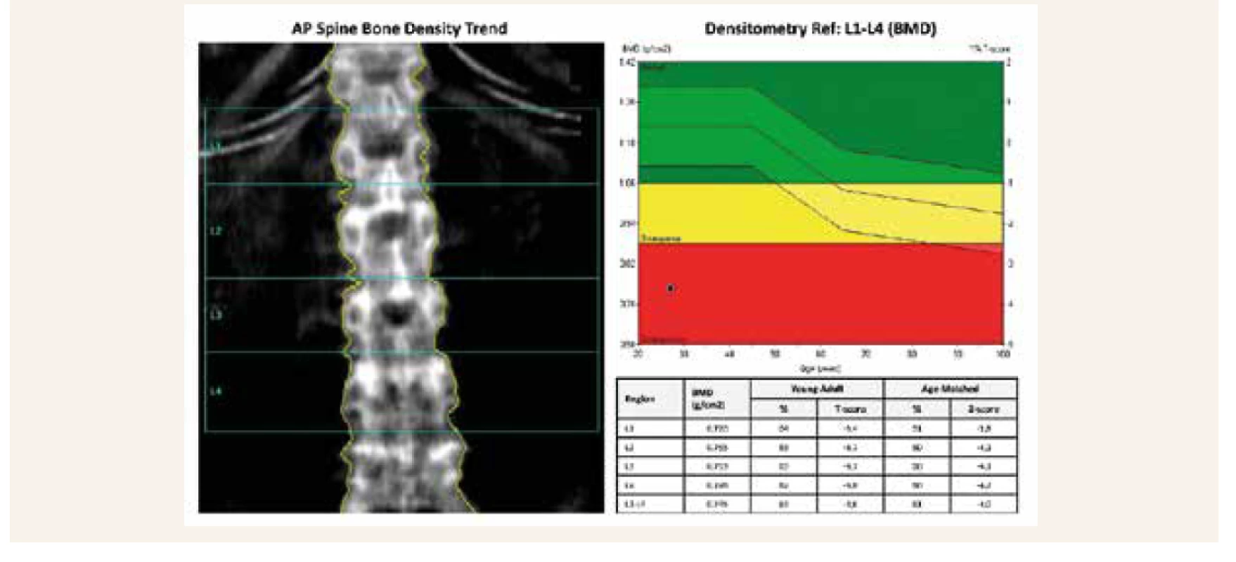 Úvodní denzitometrický nález osteoporózy u L-páteře, T-skóre -3,6 SD; Z-skóre v oblasti -4,0 SD (archiv autorů)