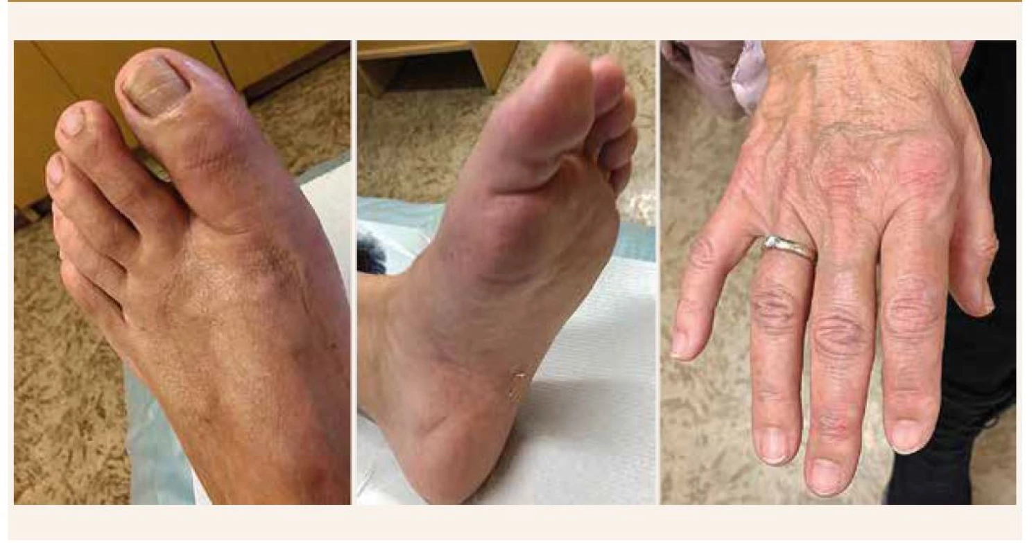 Vícečetná daktylitida (palec levé nohy, ukazovák pravé ruky) u pacientky s psoriatickou artritidou.