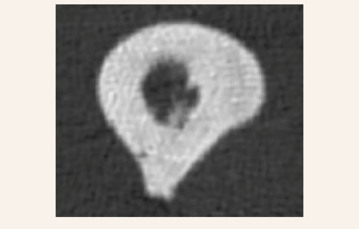 CT-scan levé stehenní kosti (15. 7. 2019 po 6 měsících léčby): vlasová linie infrakce kortikalis ve střední třetině diafýzy levého femoru již není zřetelná