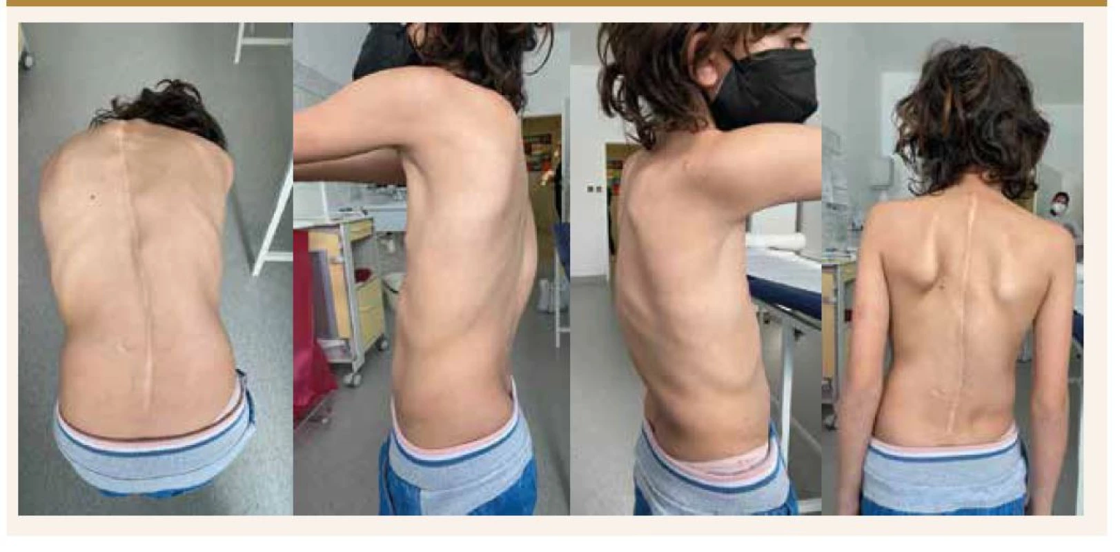 Klinický nález u pacientky 1,5 roka od operačného výkonu na chrbtici.