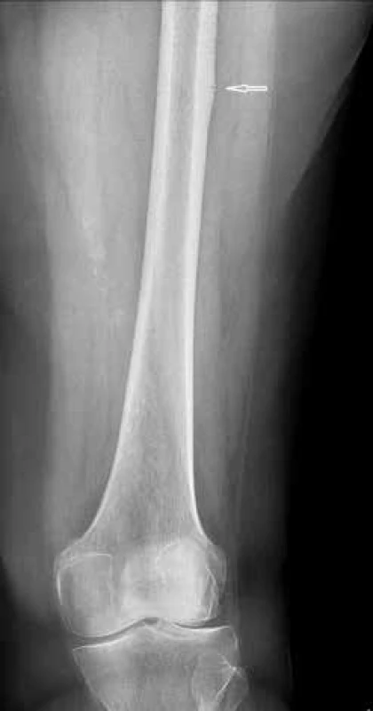  Recidiva atypické fraktury levého femuru u pacientky 7 let po vysazení bisfosfonátů