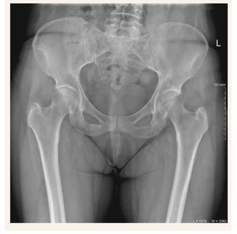 Kontrolná RTG-snímka panvy 7. mesiac po
začiatku ťažkostí so zhojením zlomeniny
dolného ramienka lonovej kosti vpravo bez
prítomnosti hyperkalusu