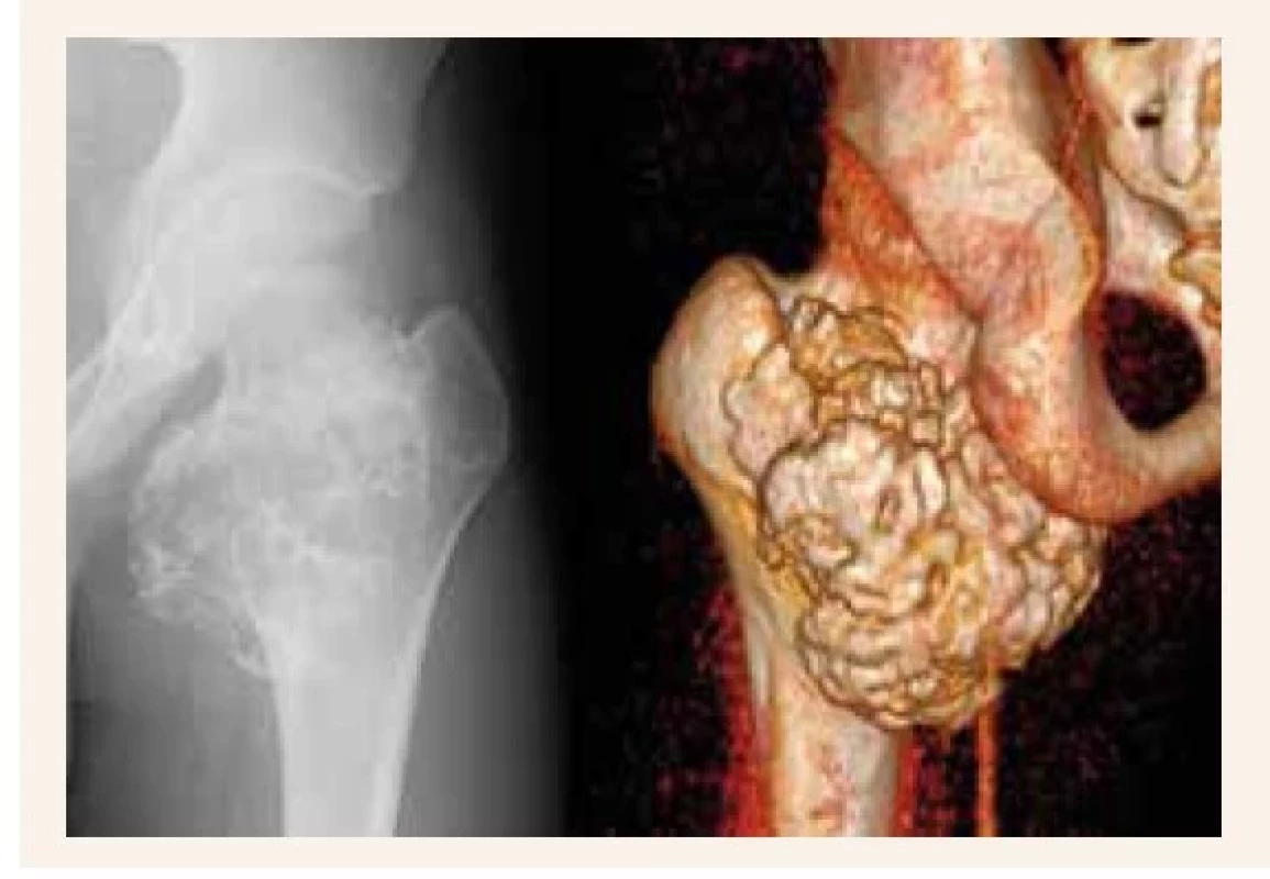 RTG – masívny proces lokalizovaný v oblasti
krčku ľavého femuru (obr. 1.1). CT-3D-vyšetrenie
so zobrazením ciev (obr. 1.2)