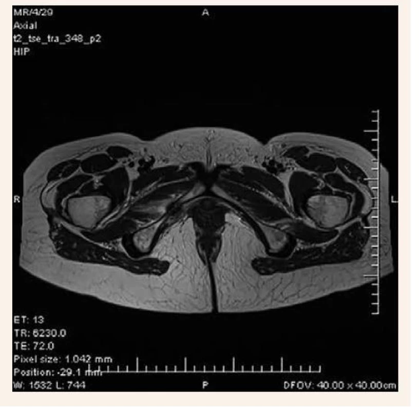 MRI-vyšetrenie 2 mesiace od začiatku bolestí
s popísanou insuficientnou zlomeninou dolného
ramienka lonovej kosti vpravo