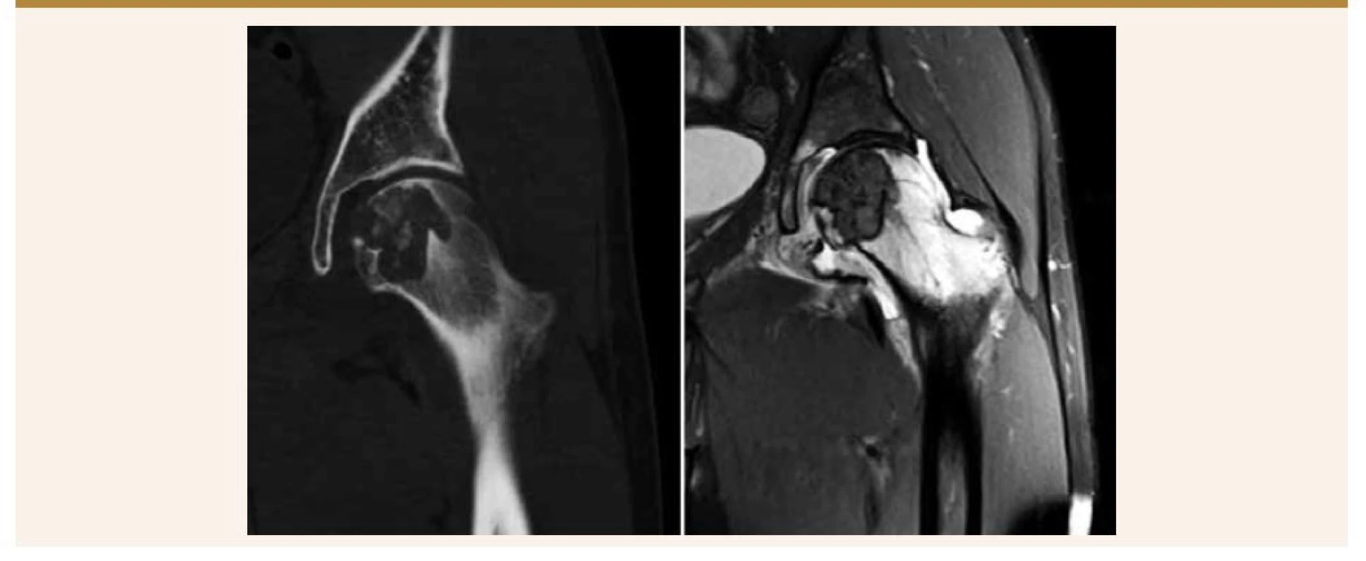 Vľavo: CT-snímka ukazuje lytické ložisko, dobre ohraničené, centrálne prítomné kalcifikácie. Vpravo: MRI so
zápalovými zmenami v bedrovom kĺbe a výrazným kostným edémom krčku stehennej kosti.