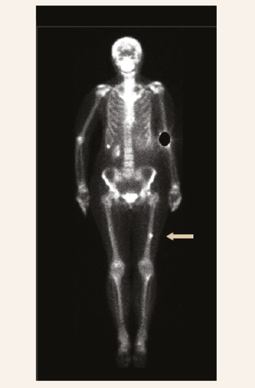Kostní scintigrafie 99mTc značeným oxidronátem disodným (11. 1. 2019, vstupní): „osteoblastické ložisko“ v diafýze levého femoru