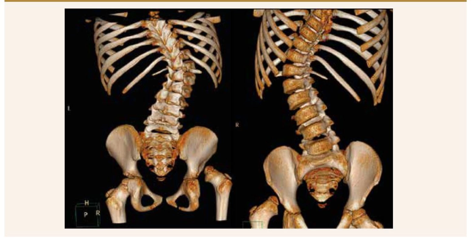 CT-vyšetrenie bedrových kĺbov a torakolumbálnej chrbtice s 3D-rekonštrukciou.