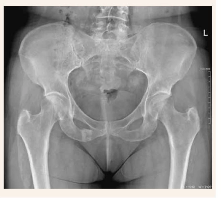 RTG-snímka panvy 4 mesiace po začiatku
ťažkostí s evidentnou pretrvávajúcou lomnou
líniou v oblasti dolného ramienka lonovej kosti
vpravo so sklerotickými okrajmi a kraniálnym
zahrotením