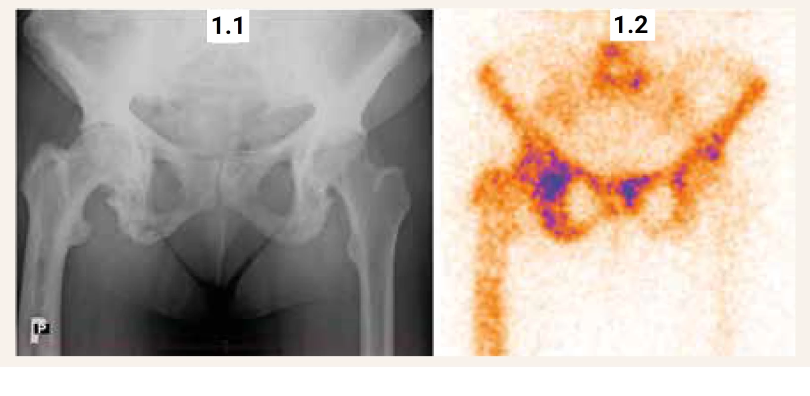 RTG a scintigrafický nález u 63leté ženy s Pagetovou kostní chorobou v oblasti pánve a pravého femuru.
(1.1) RTG nález: hrubá skvrnitě pruhovitá přestavba pánve a pravého femuru s převahou sklerotických změn,
která svědčí pro Pagetovu kostní chorobu (1.2) Scintigrafický nález: patologicky zvýšená aktivita v oblasti L5,
kosti křížové, v obou kostech kyčelních, sedacích i stydkých a v proximálních třech čtvrtinách pravého femuru