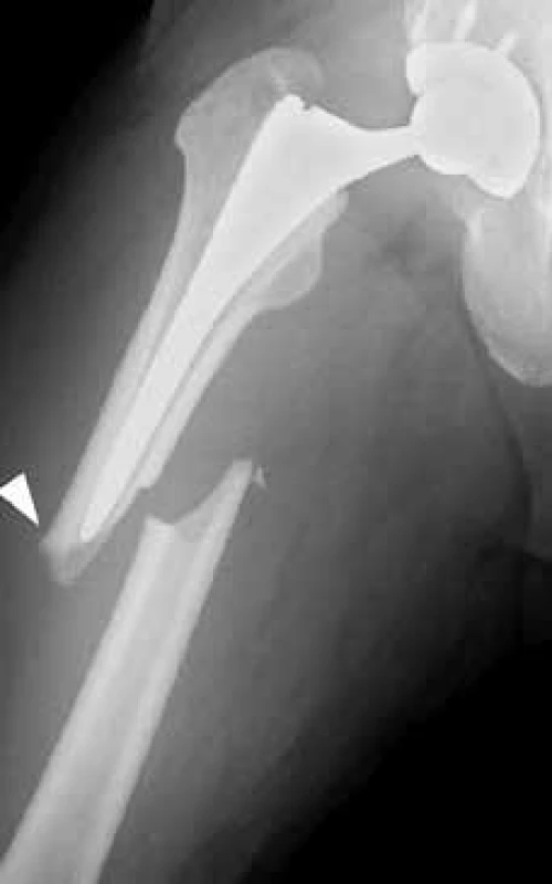  Periprotetická zlomenina s radiologickým obrazem atypické fraktury femuru. Upraveno podle [6]
