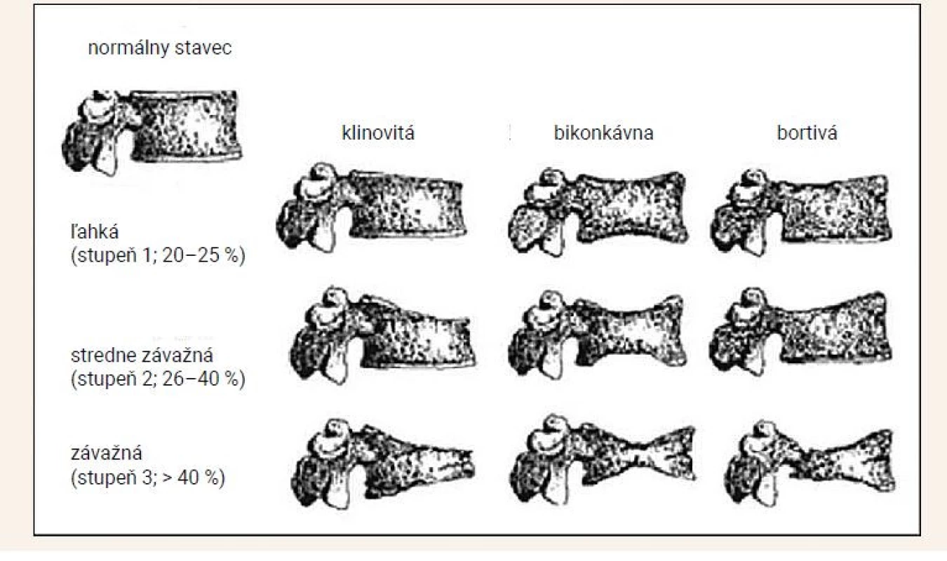 Semikvantitatívne hodnotenie zlomenín stavcov podľa Genanta. Upravené podľa Genant HK, Wu CY,
van Kuijk C et-al. Vertebral fracture assessment using a semiquantitative technique. J Bone Miner Res 1993;
8(9): 1137–1148.